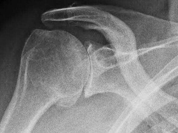 Рендгенски снимак раменог зглоба захваћеног артрозом