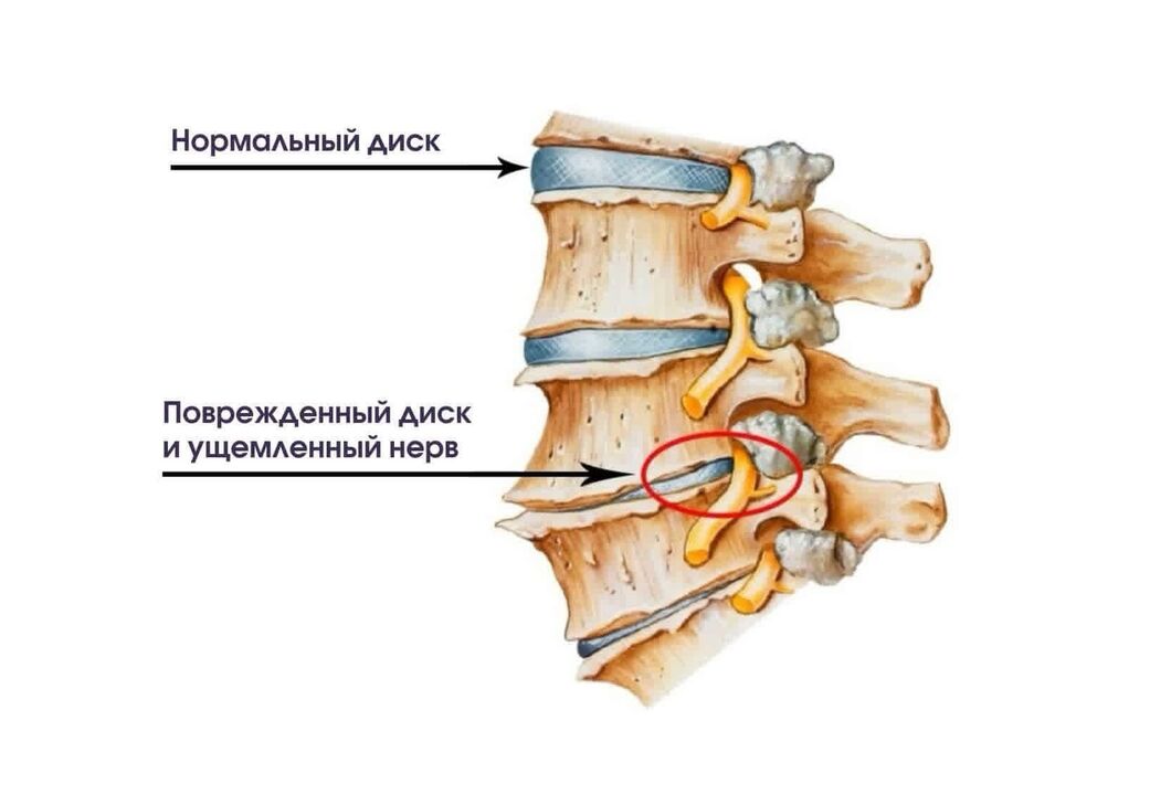 Симптоми цервикалне остеохондрозе
